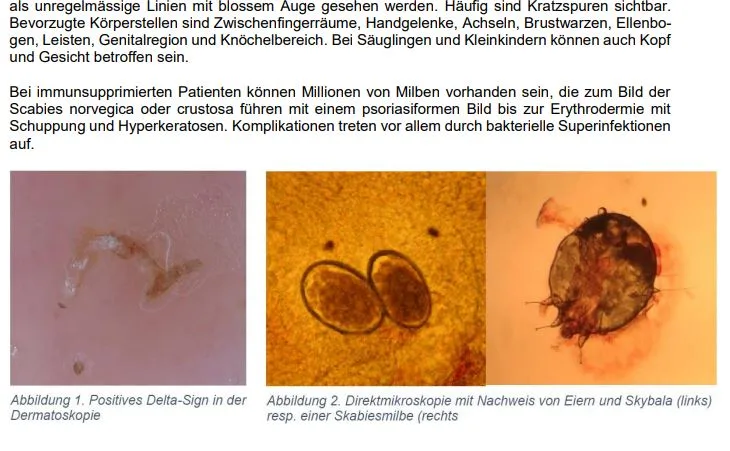 So informierte der Kanton mit einem Merkblatt über Krätze.